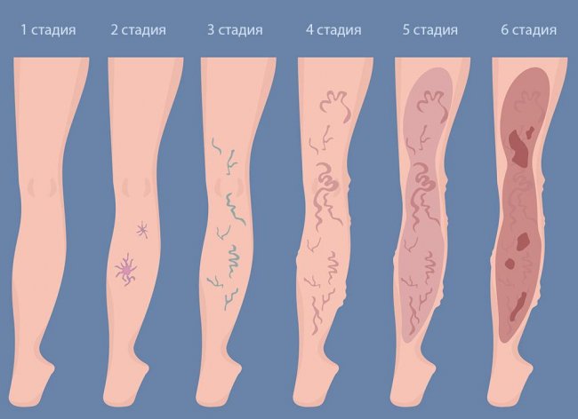 Обзор нескольких способов удаления варикоза на ногах - «Женский взгляд»