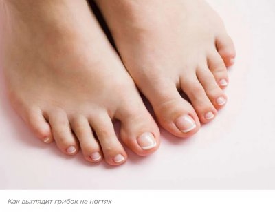 Грибок ногтей на ногах: симптомы, причины, лечение