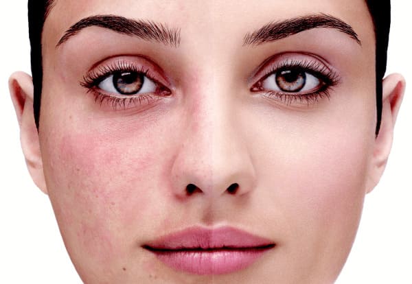 Эффективные способы избавления от рубцов и шрамов на лице - «Красота и Здоровье»