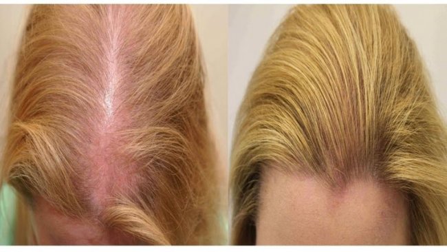 Как прекратить выпадение волос с помощью натуральных средств - «Красота и Здоровье»
