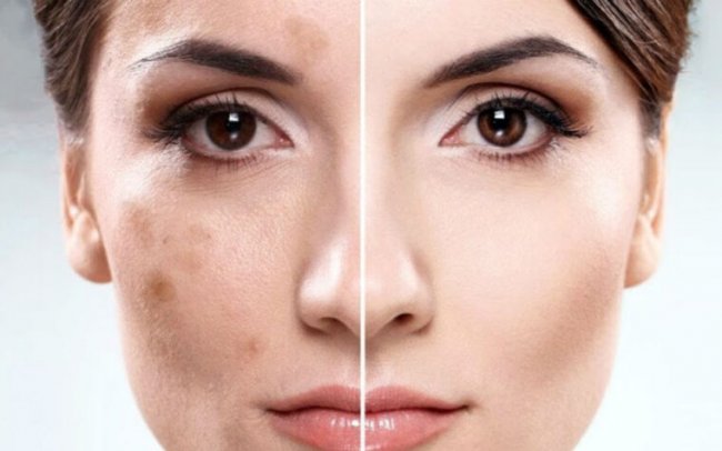 Как убрать пигментацию на лице в салоне у косметолога и в домашних условиях - «Красота и Здоровье»