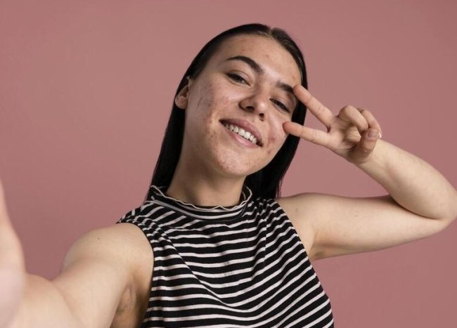 Мифы об акне: правда и заблуждения о проблемной коже - «Секреты красоты»