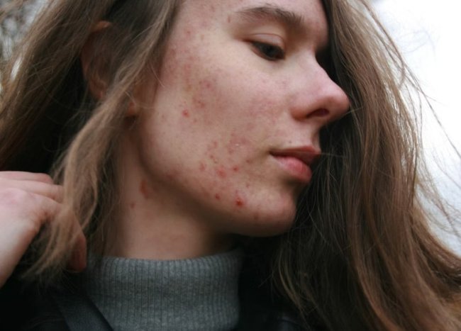 Третиноин: почему его называют золотым стандартом в борьбе с акне - «Секреты красоты»